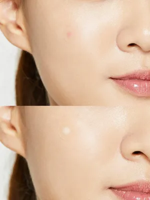 COSRX Acne Pimple Master Patch (24 Patches) | Original Korean Acne Patch!