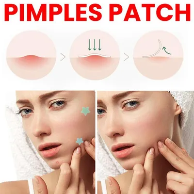 40 Pcs Acne Pimple Patch Sticker (1 set)